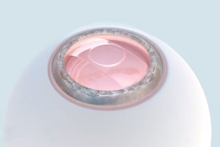 依鏡PRL晶體植入術注意事項，尤其第二步！